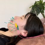 お顔の弛みが気になったら、リフトアップに特化した「お顔を鍛える美容鍼」がお薦め！