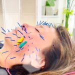 岐阜市で美容鍼100本の施術を受けるならアクア治療院へ