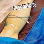 長引く足底筋膜炎の痛みや違和感、改善するための鍼治療