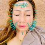 お肌の衰えはターンオーバーの遅延、ハリもぐら美容鍼100で甦れ私の美肌