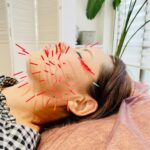 岐阜で美容鍼のハリ数100本をお探しならアクア治療院へ