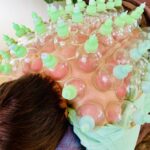 岐阜で全身の吸い玉、カッピングをするなら、アクア治療院へ